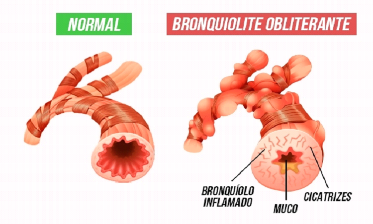 A bronquiolite viral aguda causa dificuldades respitatórias